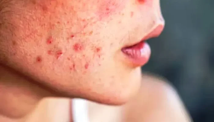 5 Penyebab Bruntusan di Wajah yang Sering Diabaikan