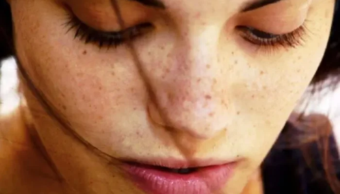 Kapan Flek Hitam Perlu Diwaspadai? Kenali Tanda-Tanda Melanoma