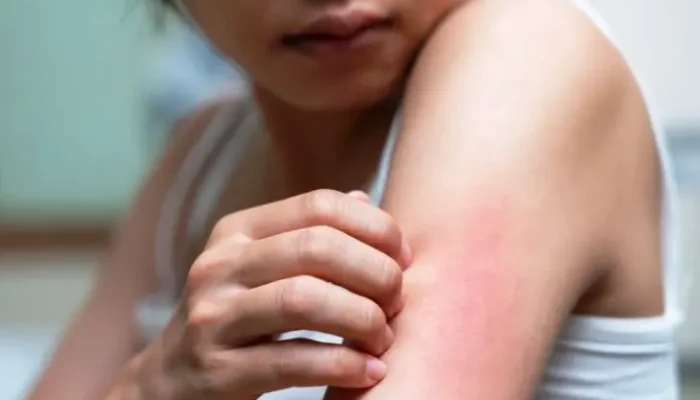 Gatal Tanpa Sebab? 7 Penyakit Serius yang Mungkin Menyebabkan Kulit Terus Gatal