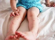 Gatal di Malam Hari: Kenapa Makin Parah Saat Mau Tidur dan Cara Mengatasinya