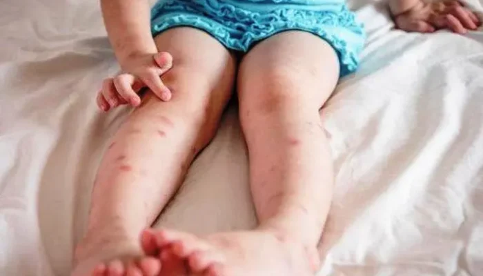 Gatal di Malam Hari: Kenapa Makin Parah Saat Mau Tidur dan Cara Mengatasinya