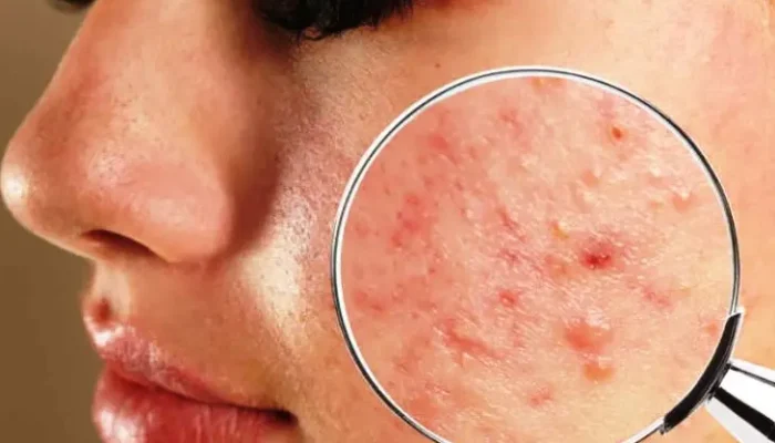 Skincare Routine untuk Jerawat Hormonal yang Bandel di Usia 30+