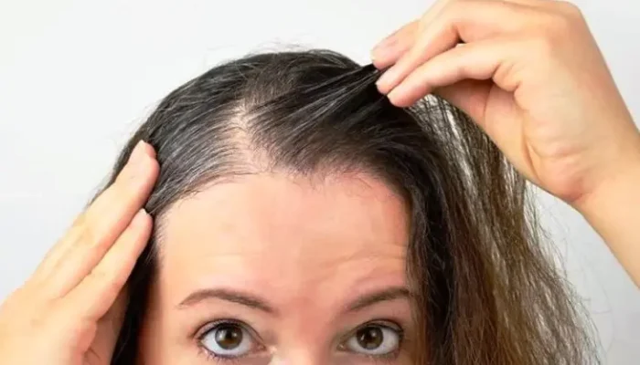 Kebotakan Dini pada Pria & Wanita: Penyebab dan Solusi Tepat