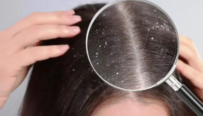 Ketombe Membandel? Coba 5 Bahan Alami Ini untuk Mengatasinya!