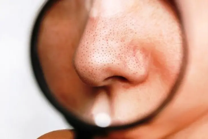 5 Kesalahan Skincare yang Justru Bikin Komedo Makin Banyak