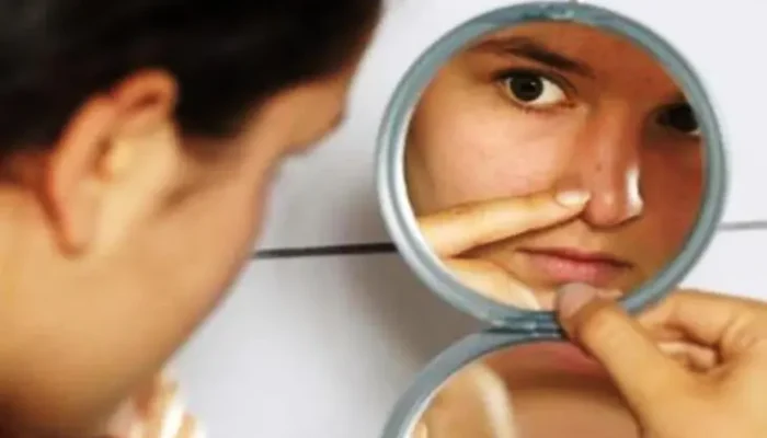 Komedo di Hidung Bandel? Ini Penyebab dan Solusi Permanennya