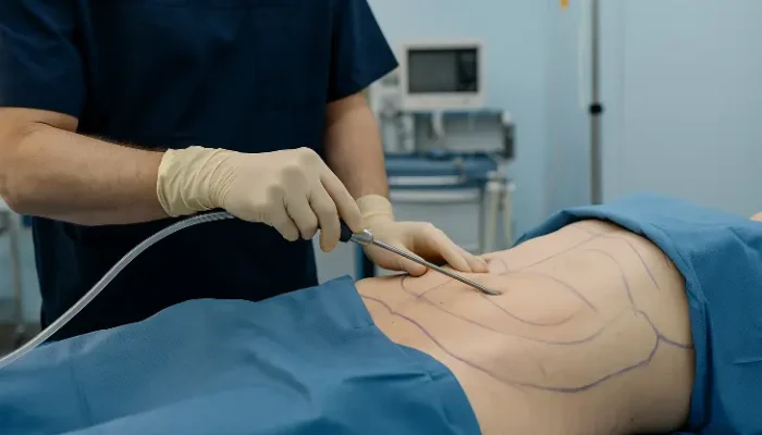 Fakta Sedot Lemak: Prosedur, Jenis, Efek Samping, dan Hal-Hal yang Harus Kamu Tahu!